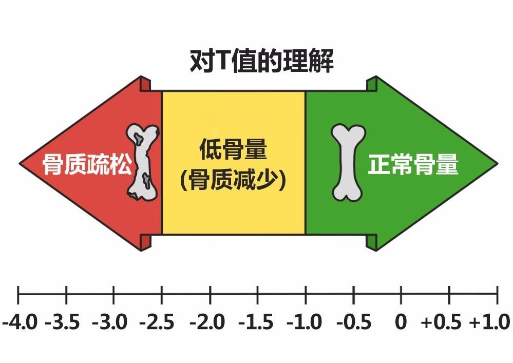 关于骨密度检查 你想知道的都在这儿